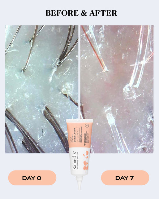 Pre-Shampoo Scalp Lotion | SCALP CONTROL