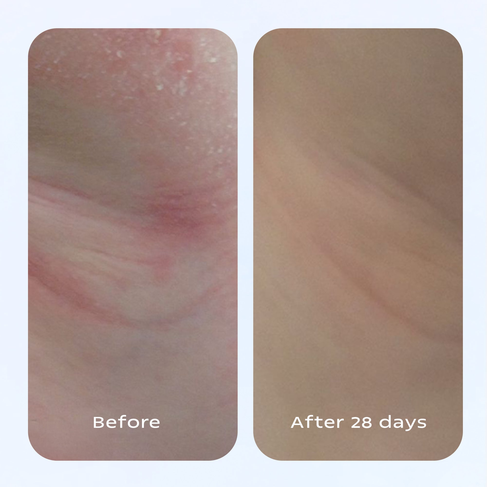 Eczema Therapy Cream