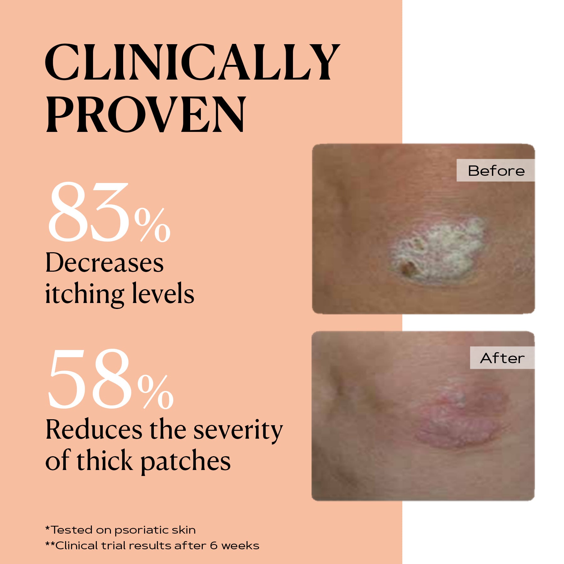 PSO CONTROL rich body cream – Multi-Symptom Relief for Dry & Flaky Skin